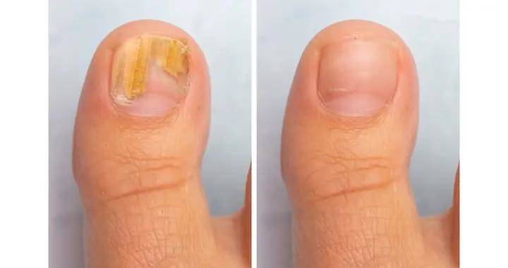 甲癣会带来什么危害？