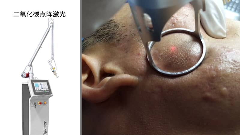 痘坑到底应该怎么去除?