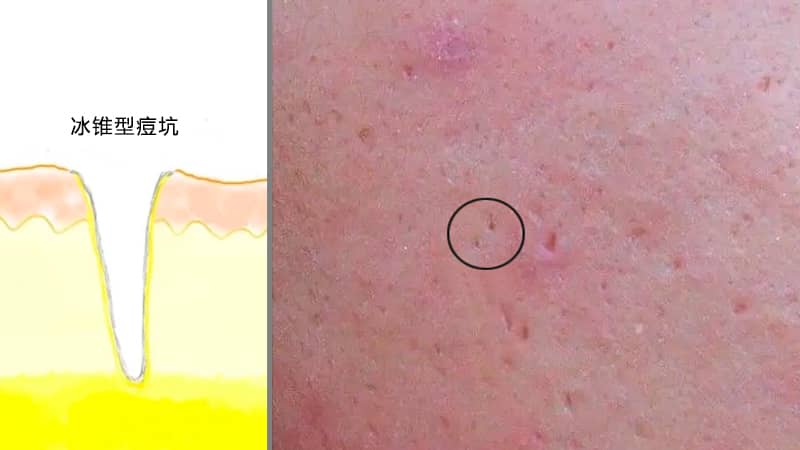 痘坑到底应该怎么去除?
