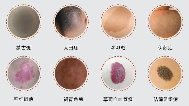 激光去除胎记需要多少钱？