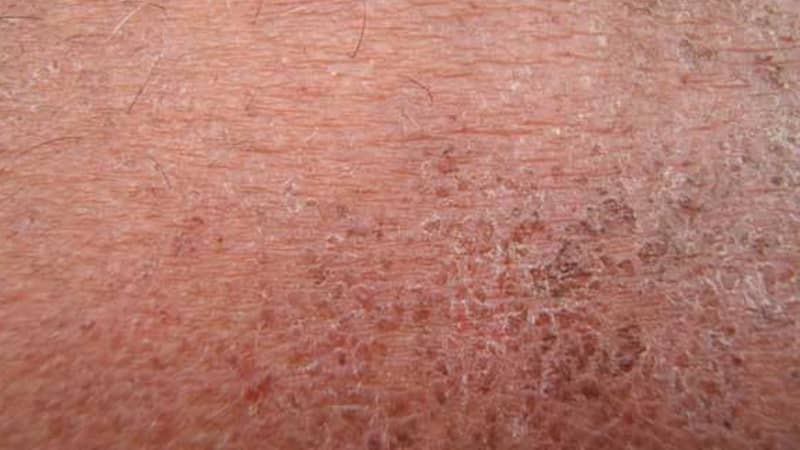 夏天常见皮肤病有哪些?