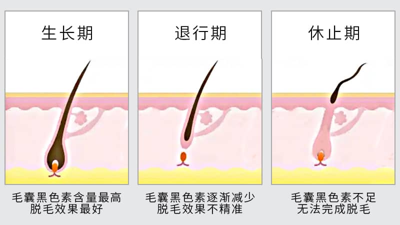 激光脱毛常见问题解答