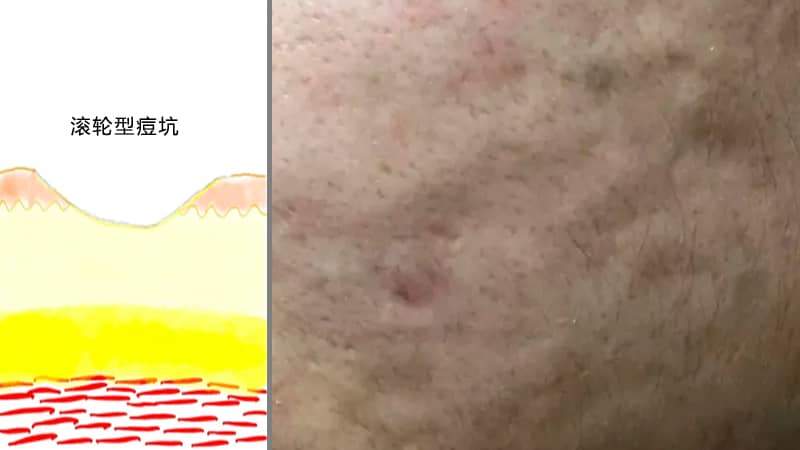痘坑到底应该怎么去除?