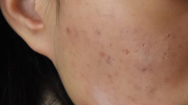 痘坑到底应该怎么去除?