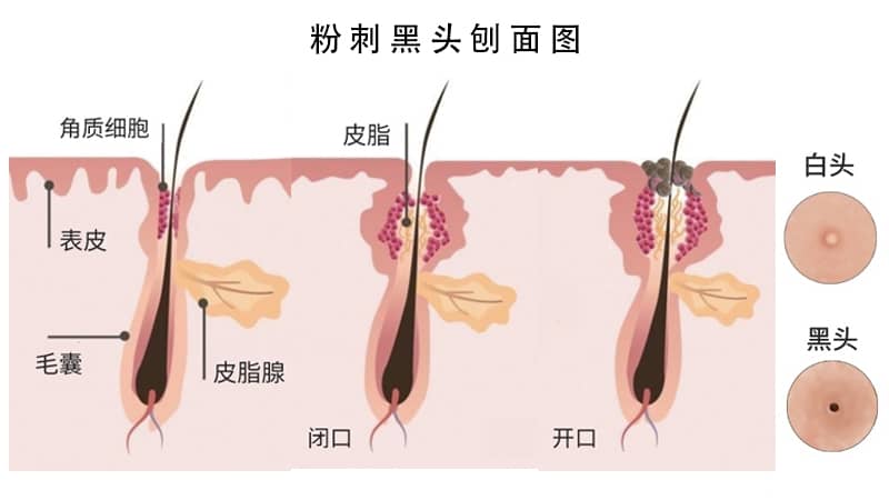 痘痘针清治疗过程