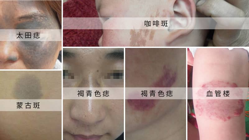 胎记是怎么形成的？