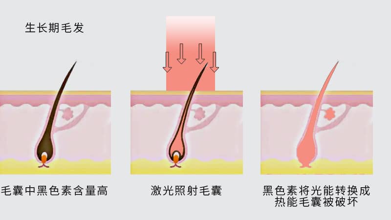激光脱毛常见问题解答