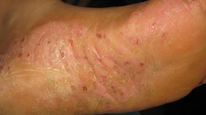 夏天常见皮肤病有哪些?