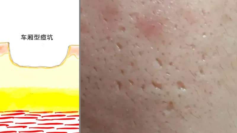 痘坑到底应该怎么去除？