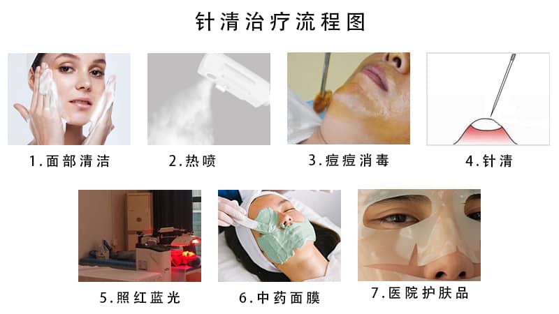痘痘针清治疗过程