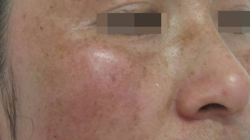 黄褐斑是怎么形成的?