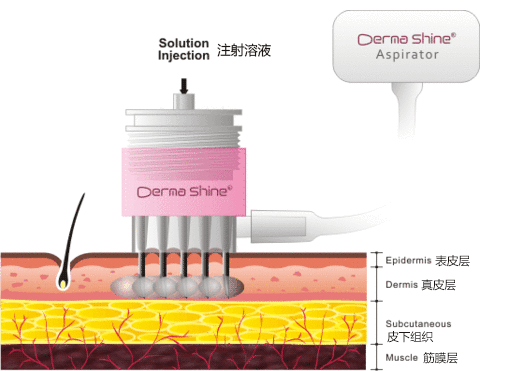 【临泉华康皮肤医院】水光针机打和手打效果有什么区别?