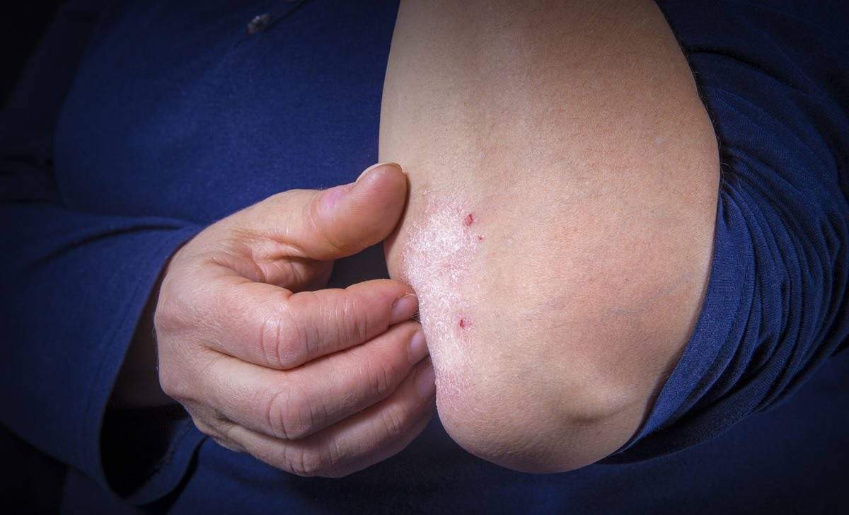 【临泉华康皮肤医院】秋季容易引发皮肤瘙痒，你应该注意什么？