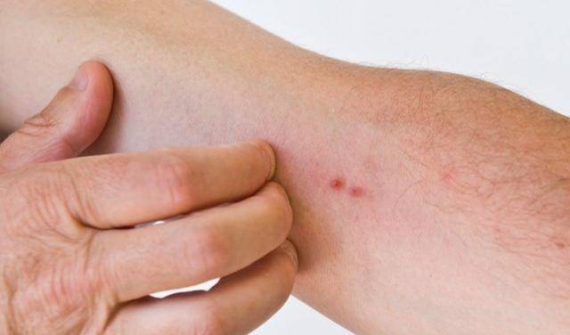 皮肤上面起红色疹子痛痒怎么办?