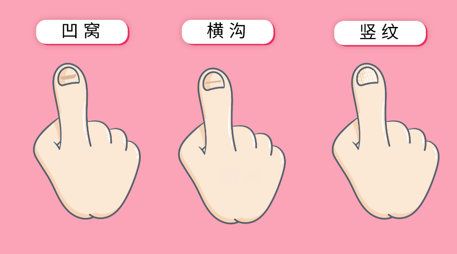 【临泉华康皮肤病医院】指甲出现竖纹是什么原因呢?