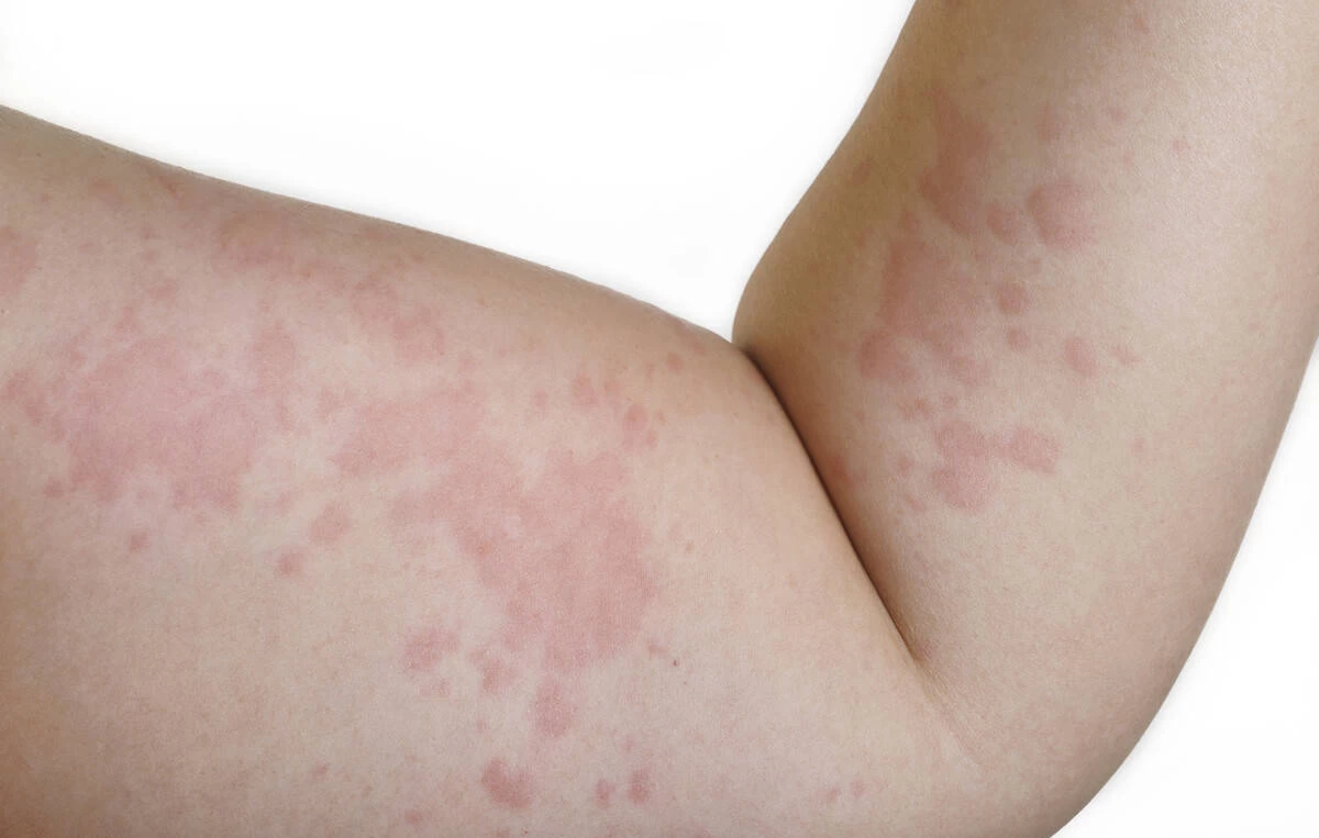 为什么突然皮肤过敏、瘙痒了？