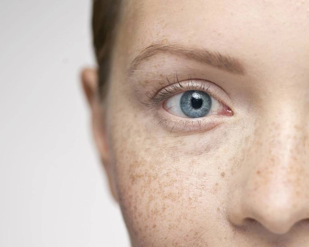 激光祛斑,激光术后应该如何护肤?