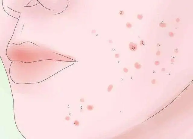 为什么会长扁平疣？长扁平疣有什么影响？