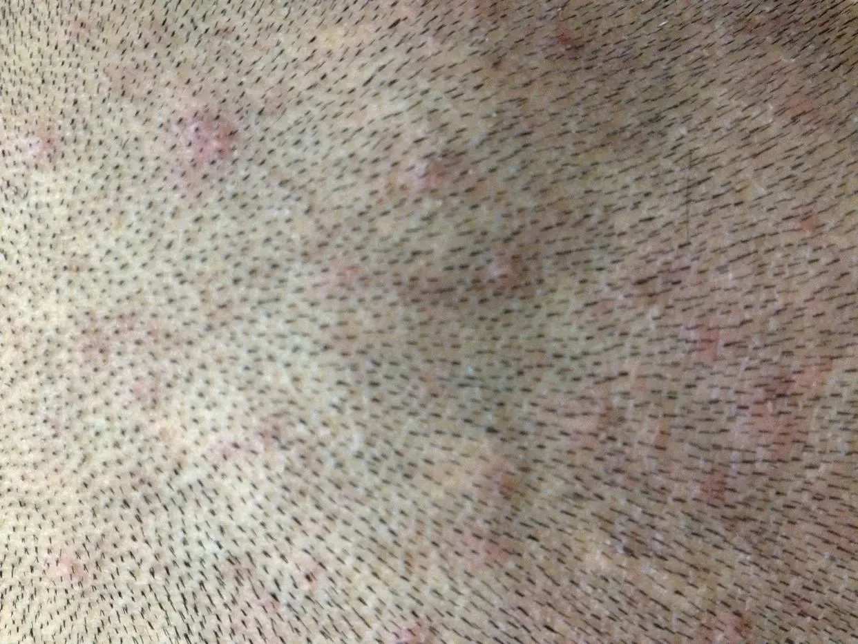 青少年如何预防头部毛囊炎的发生？