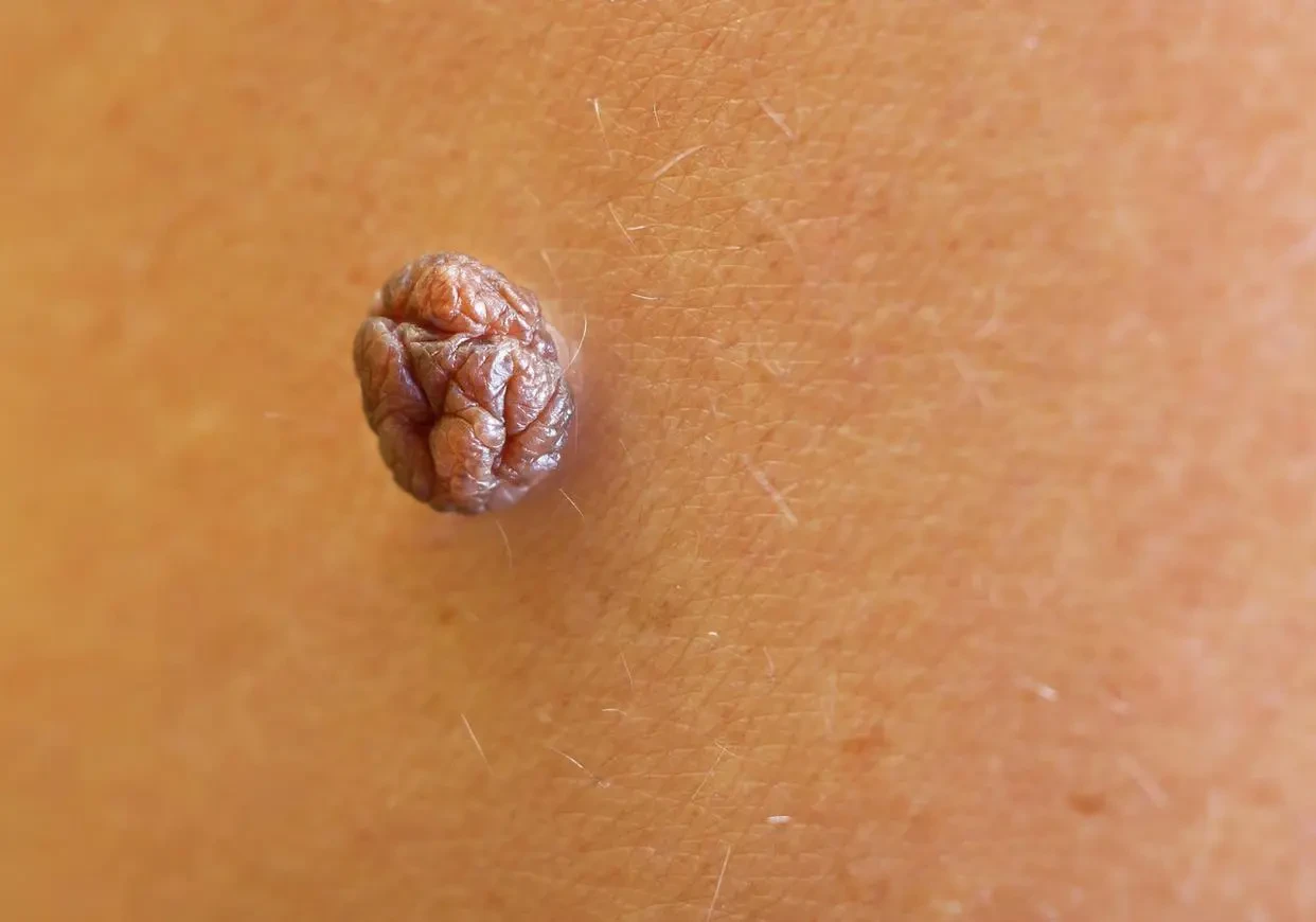 身体长疣,可以用手抓吗?