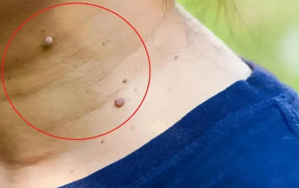 扁平疣是属于性传播吗？会自己消退吗？