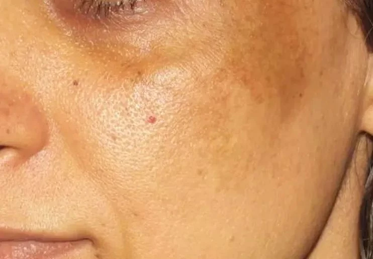 生活中常见的色斑有哪些呢？