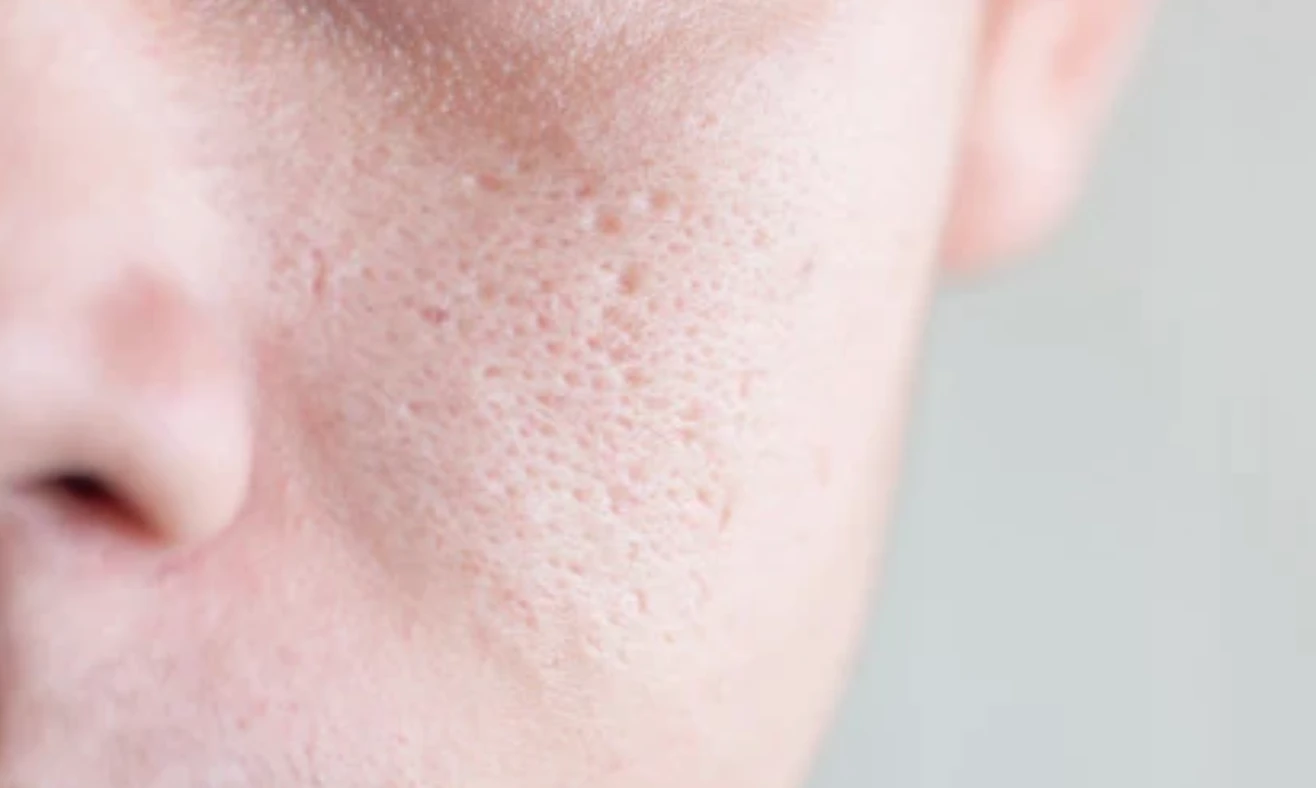 毛孔粗大有哪些类型?你是属于哪一种?