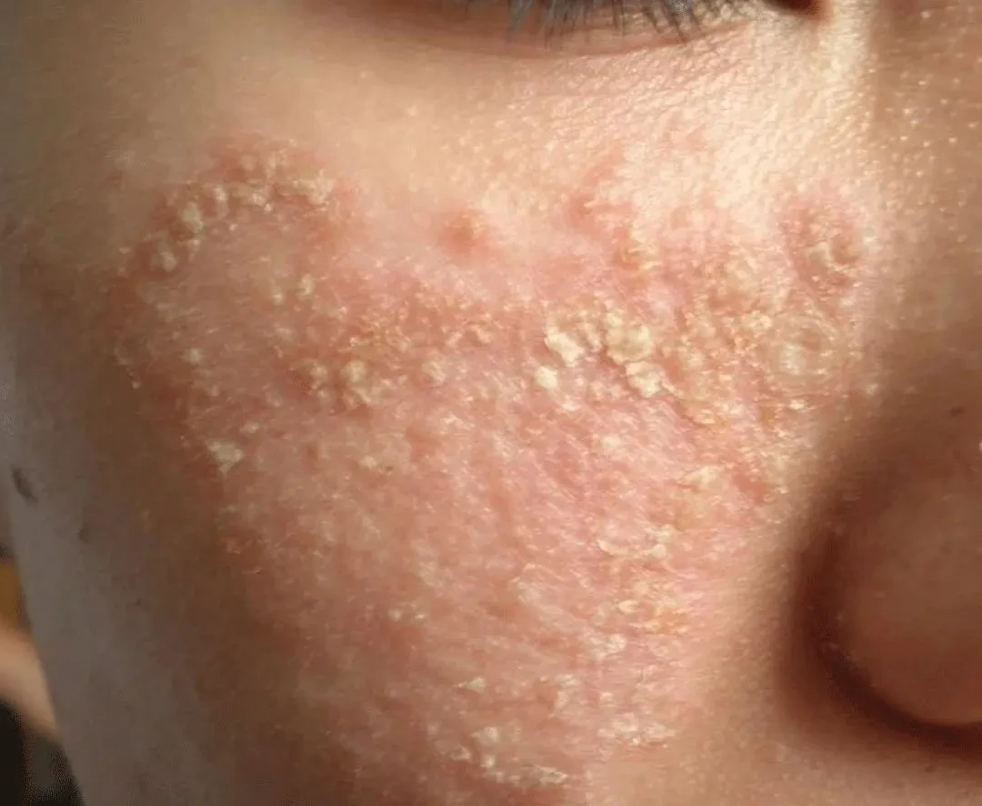 激素脸如何形成？