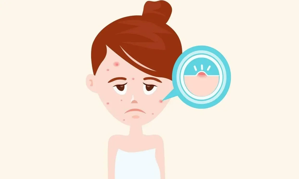 为什么长了痘痘还会留下痘印呢?