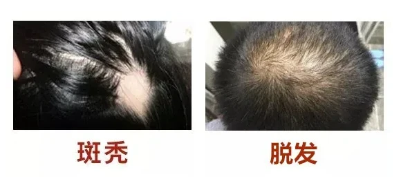脱发与斑秃的区别？