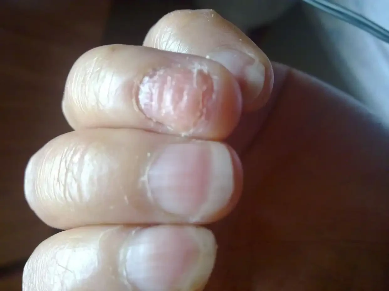 手指甲坑坑洼洼是什么原因导致？