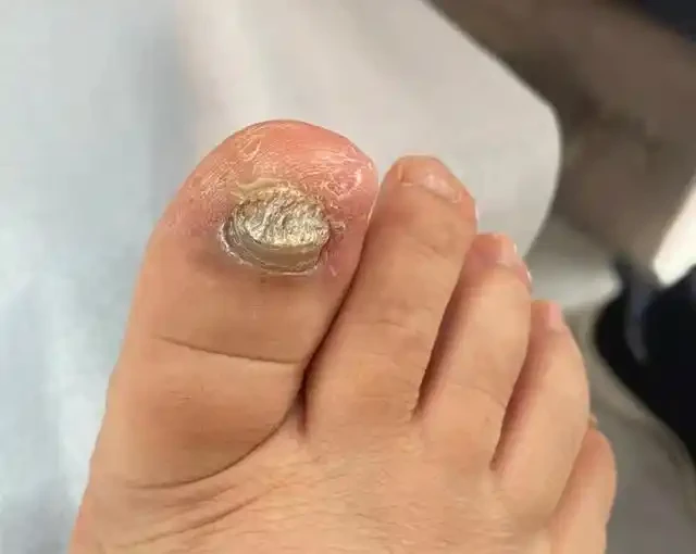 灰指甲会自愈吗？