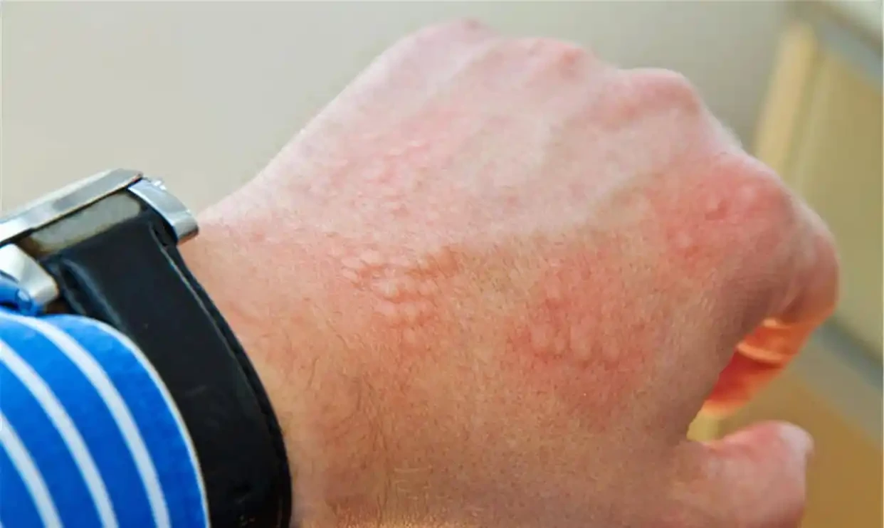 荨麻疹是如何发生的？生活中该如何预防？