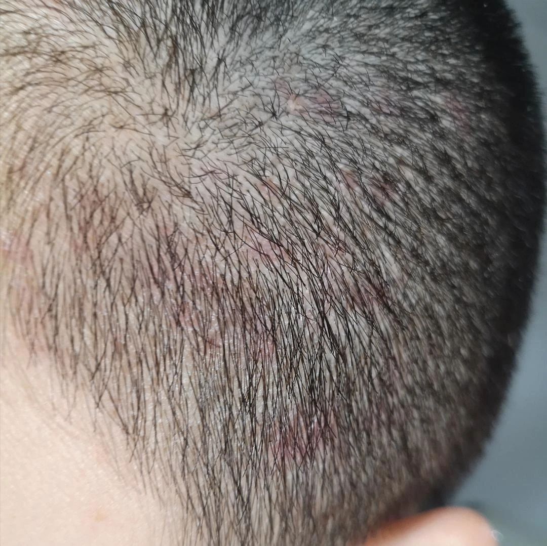 毛囊炎好发于夏季吗?应该如何护肤?