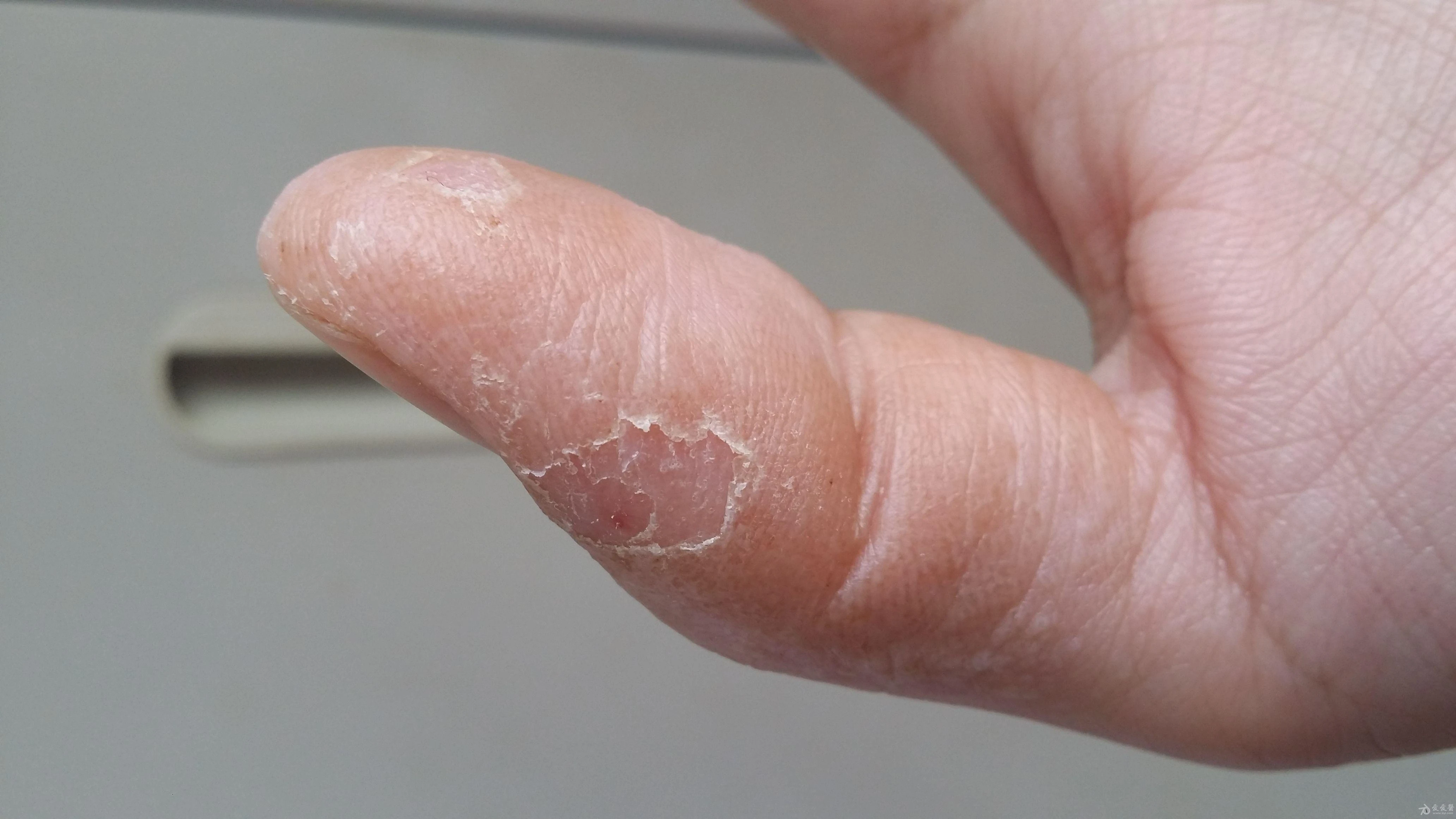 手指脱皮什么原因?